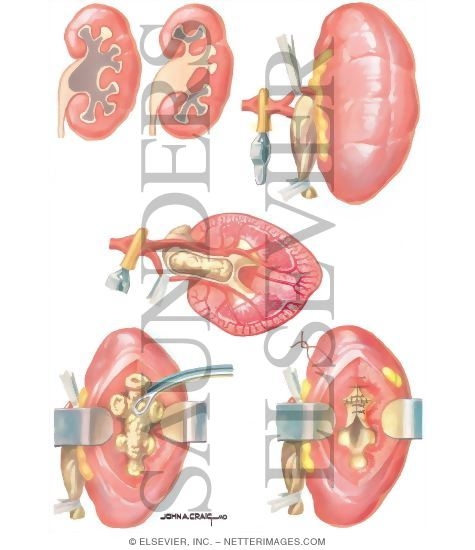 Urinary Calculi: Anatrophic Nephrolithotomy