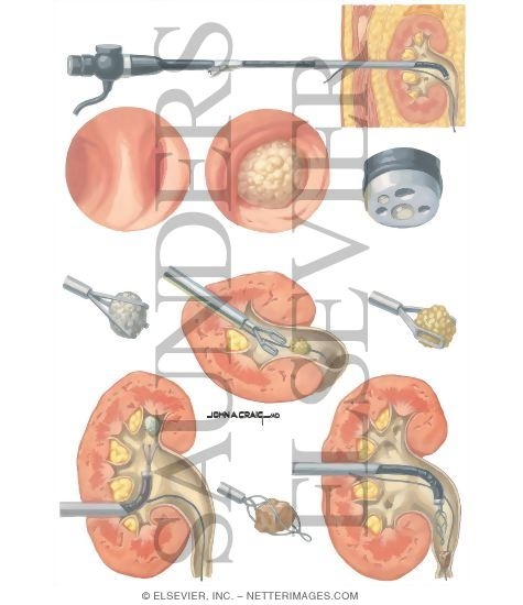 Renal calculi thesis picture