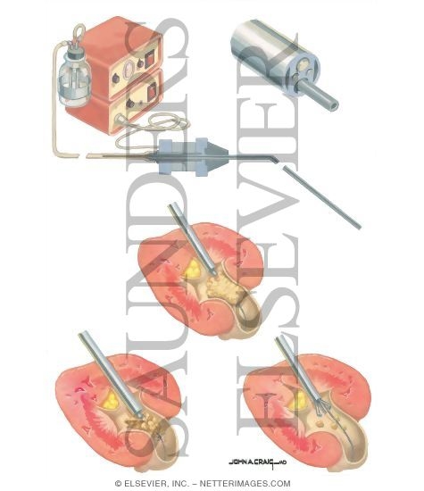 Urinary Calculi: Percutaneous Ultrasonic Lithotripsy