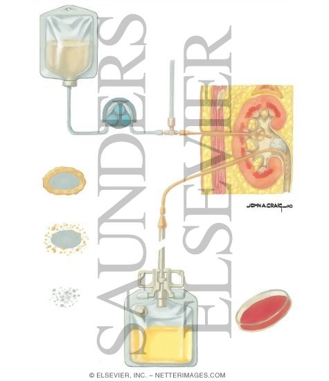 Urinary Calculi: Chemolysis of Urinary Calculi