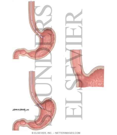 Watermarked preview of unlabeled image: Hiatus Hernia: Tests for Esophageal Competency