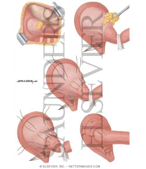 Hiatus Hernia: Belsey Mark IV Procedure