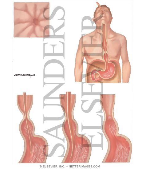 Hiatus Hernia: Peroral Bougienage