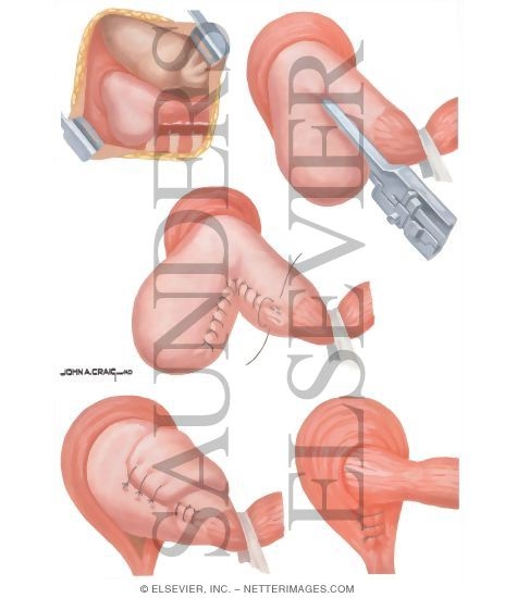 Watermarked preview of unlabeled image: Hiatus Hernia: Collis-Nissen Procedure for Peptic Stricture