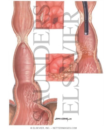 Watermarked preview of unlabeled image: Hiatus Hernia: Complications of Peptic Reflux