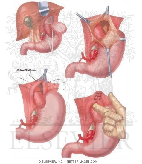 Hiatus Hernia Collis Repair Of Paraesophageal Hiatus Hernia