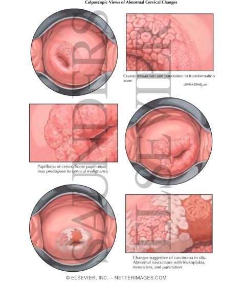 Colposcopic Views of Abnormal Cervical Changes
Carcinoma in Situ (Cervix)