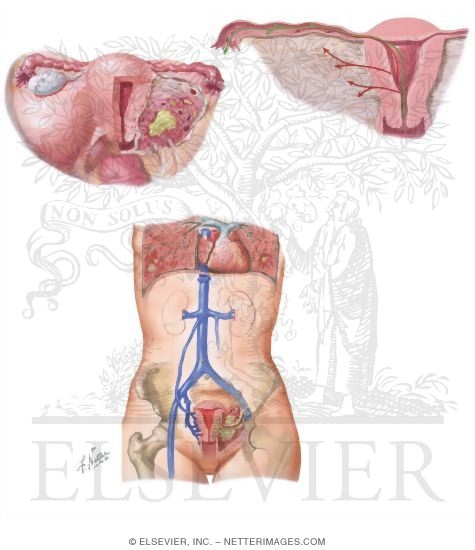 Endometritis