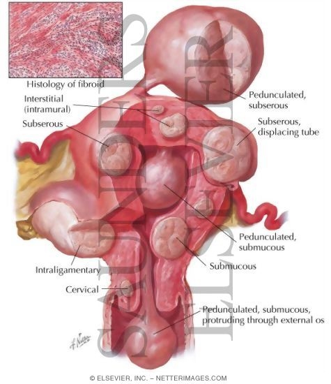 Myoma (Fibroid) I - Locations
