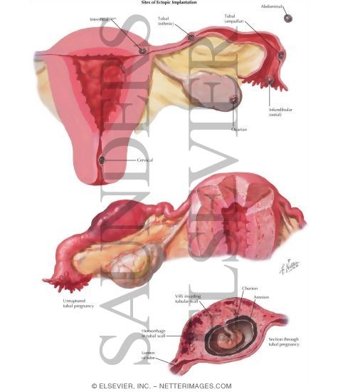 Watermarked preview of labeled image: Ectopic Pregnancy