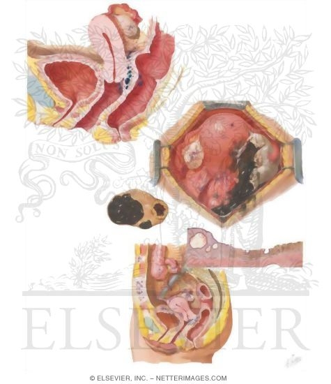 Endometriosis