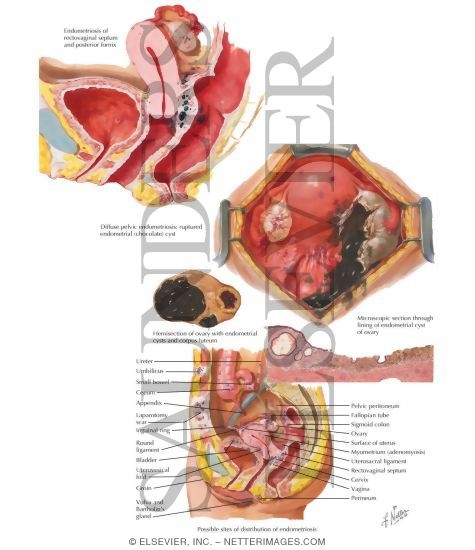Watermarked preview of labeled image: Endometriosis
