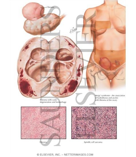 Stromatogenous Neoplasms - Fibroma, Meigs' Syndrome, Sarcoma