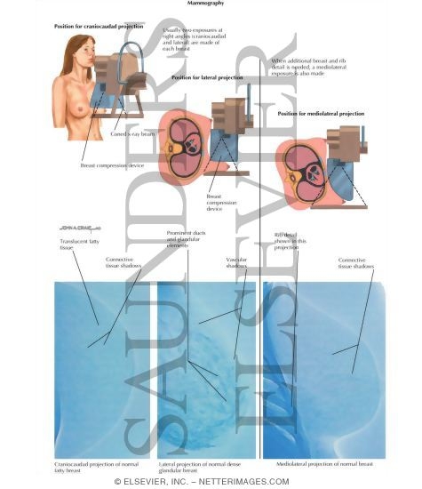 Watermarked preview of labeled image: Mammography