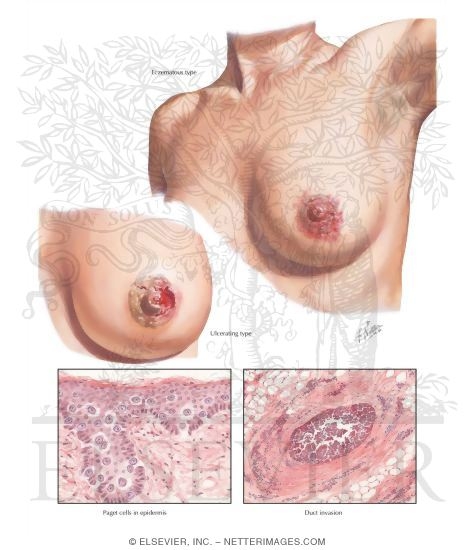 Paget's Disease of the Nipple
