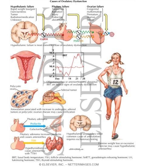 Causes of Ovulatory Dysfunction