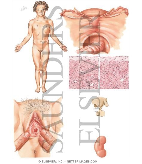 Watermarked preview of unlabeled image: Gonadal Dysgenesis