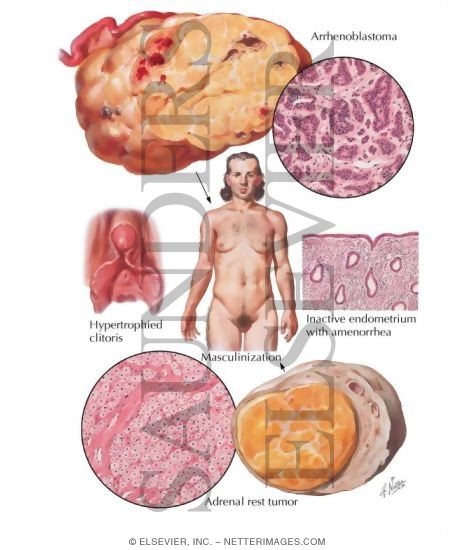 Watermarked preview of labeled image: Masculinizing Neoplasms, Arrhenoblastoma, Adrenal Rest Tumor