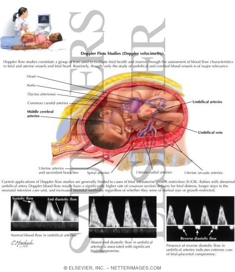 Watermarked preview of labeled image: Doppler Flow Studies (Doppler Velocimetry)
