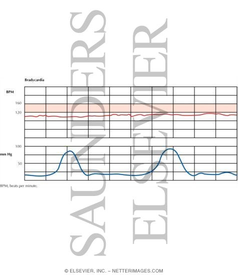 Watermarked preview of labeled image: Fetal Heart Rate Testing: Bradycardia