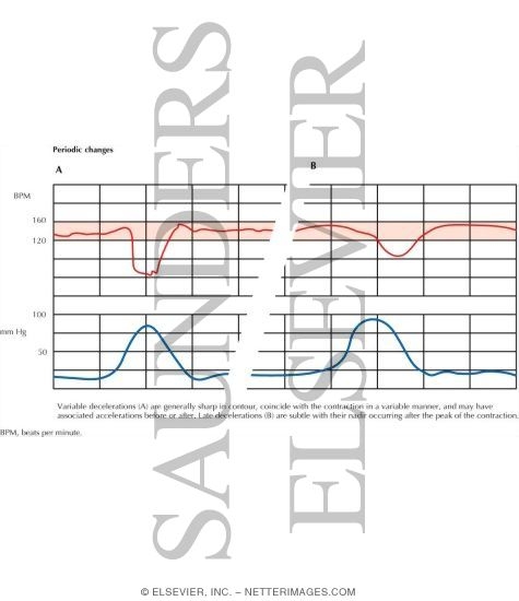 Watermarked preview of labeled image: Fetal Heart Rate Testing: Periodic Changes