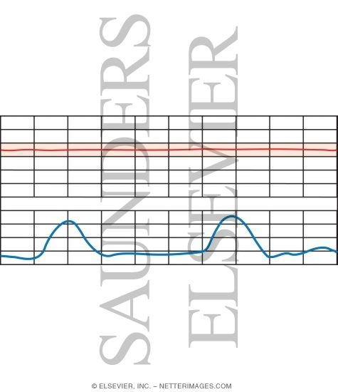 Watermarked preview of unlabeled image: Fetal Heart Rate Testing: Reduced Variability