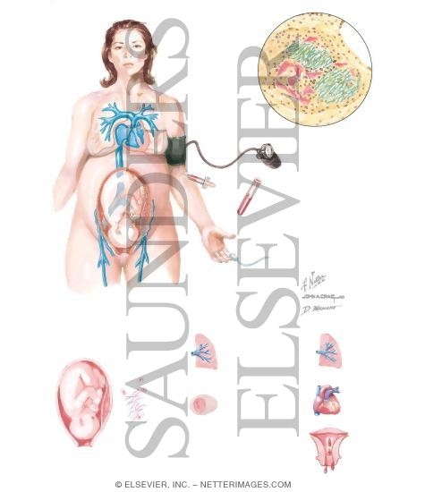 Amniotic Fluid Embolism