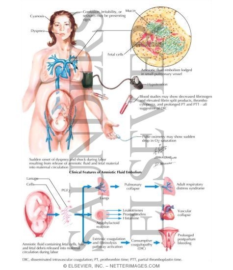 Amniotic Fluid Embolism