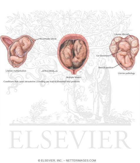 Watermarked preview of unlabeled image: Breech Birth