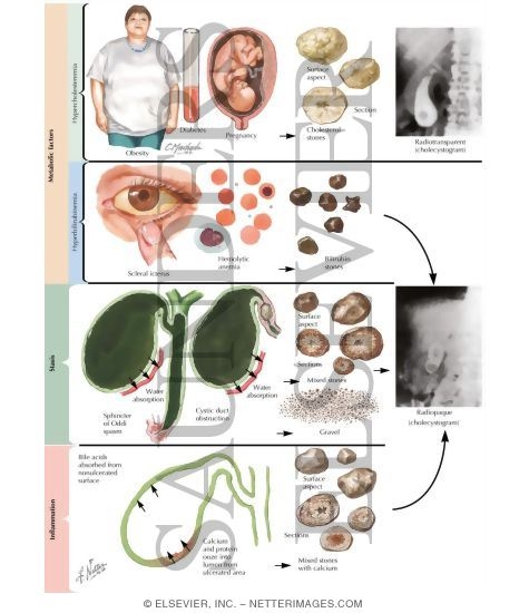 Watermarked preview of labeled image: Cholecystitis In Pregnancy