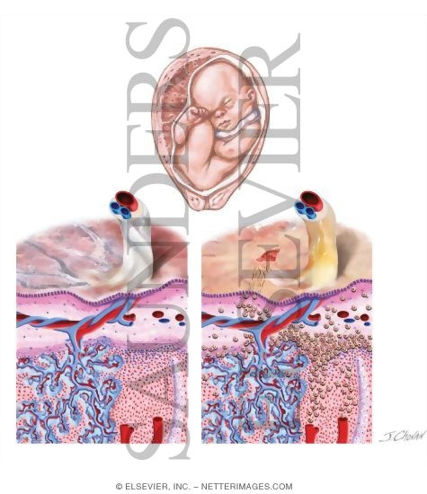 Chorioamnionitis