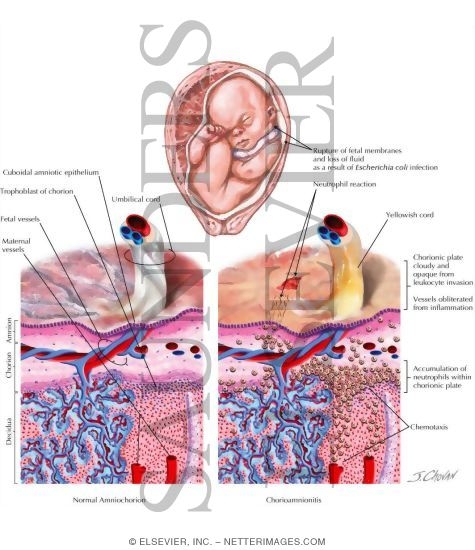 Chorioamnionitis