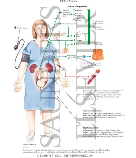 Watermarked preview of labeled image: Diabetes Mellitus In Pregnancy