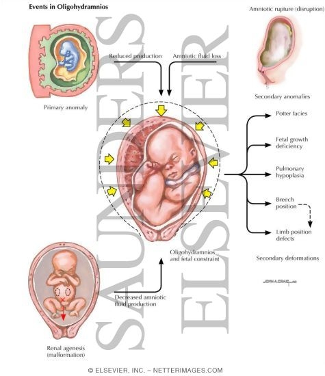 Watermarked preview of labeled image: Oligohydramnios