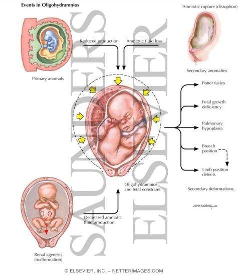 Oligohydramnios