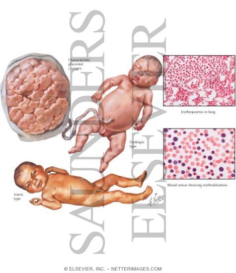 Erythroblastosis Fetalis