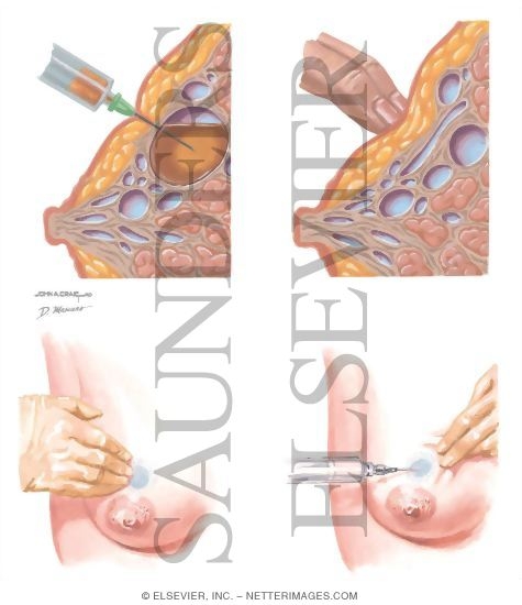 Aspiration Of Breast Cyst 74