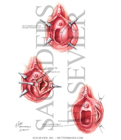 Bartholin's Gland Marsupialization