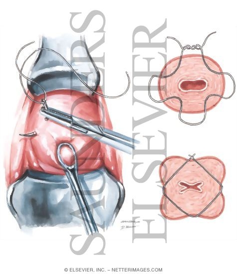 Cervical Cerclage