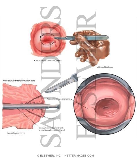 Cervical Conization (Cold Knife)