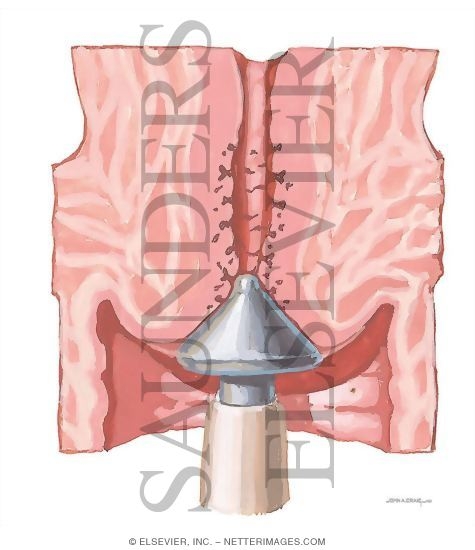 Cervical Cryocautery