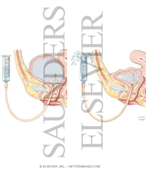Watermarked preview of unlabeled image: Urodynamic Testing: Simple