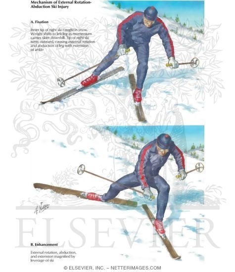 Watermarked preview of labeled image: Mechanism of Abduction-External Rotation Ski Injury