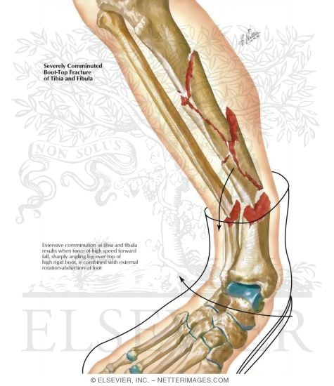 Comminuted Boot-Top Fracture