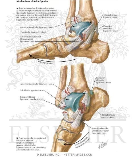Mechanisms of Ankle Sprains