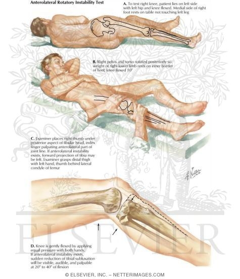 Anterolateral Rotatory Test (Slocum)