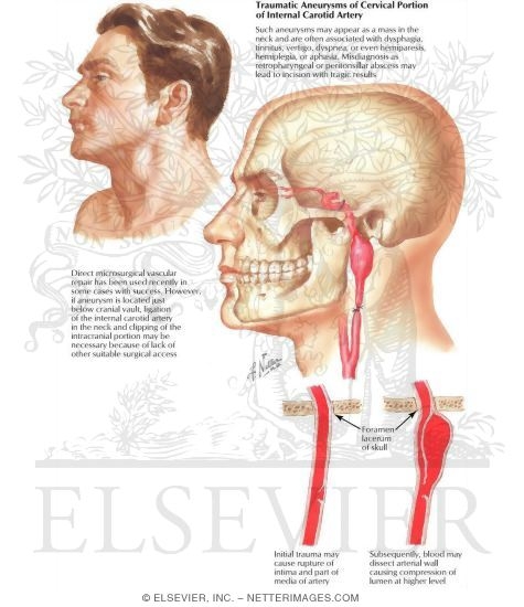 Aneurysms In the Neck