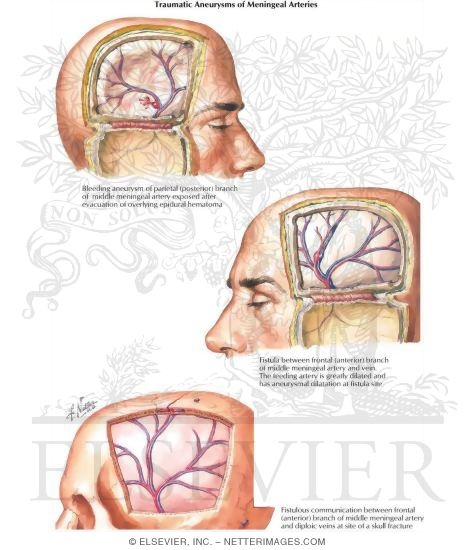 Watermarked preview of labeled image: Traumatic Aneurysms of Meningeal Arteries