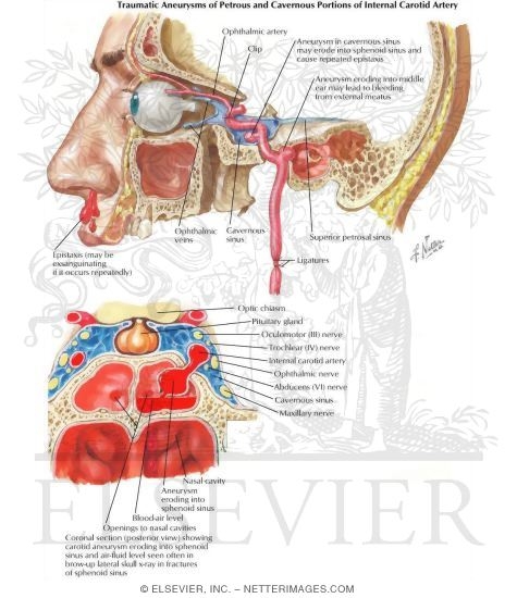 Watermarked preview of labeled image: Traumatic Aneurysms of Carotid Artery As It Transverses the Skull