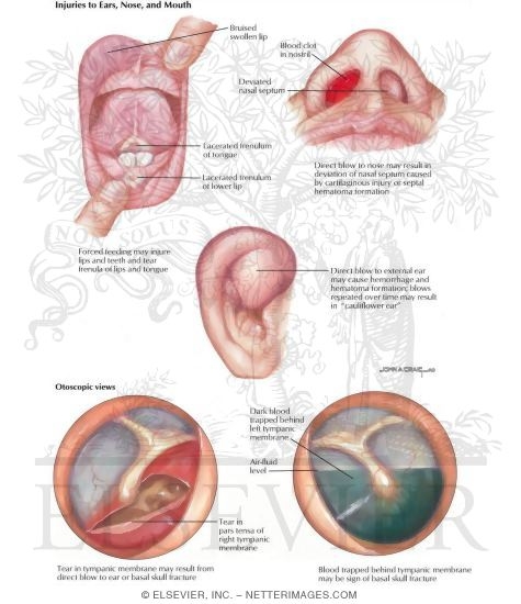 Watermarked preview of labeled image: Child Abuse: Injuries to the Ears, Nose, and Mouth